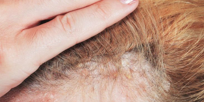 Can A Burning Scalp Lead To Hair Loss UAE