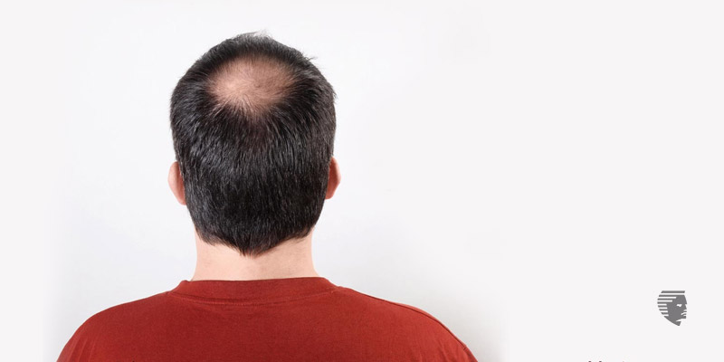 Is Hair Miniaturization Linked to Genetic Alopecia? - UAE