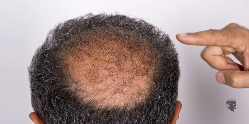 Hair restoration determinants things you need to know before you choose to act
