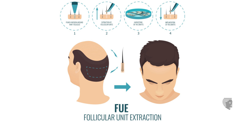 What is FUE hair transplant? PROS and CONS.