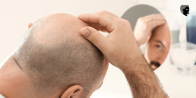 Unveiling the Complex Dilemma: Why Hair Transplants Alone Fall Short in Advanced Genetic Hair Loss