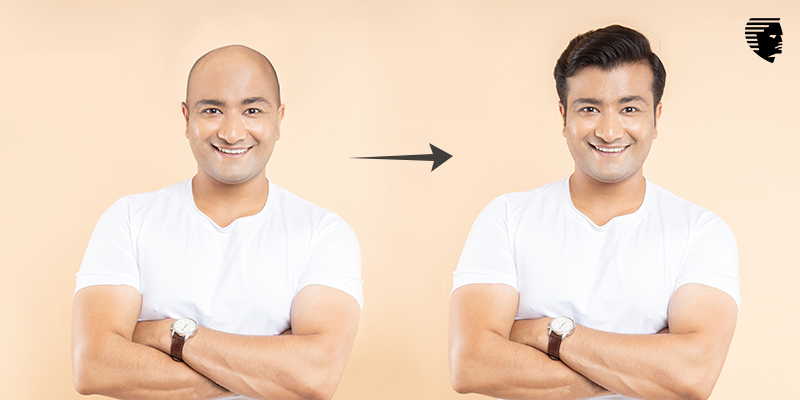 Top 10 Reasons to Get a Hair Transplant in Dubai