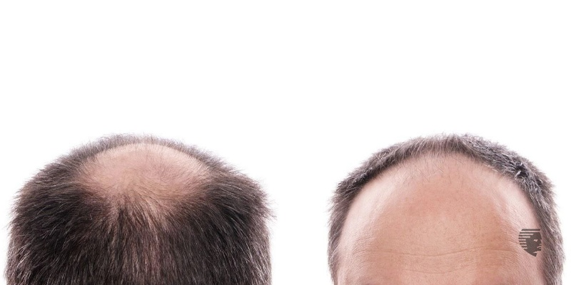 Why Do I Have a Receding Hairline and How to Stop It