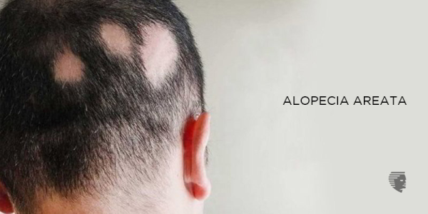 Best Treatment for Hair Loss and Alopecia Areata - Hair Transplant or Medicines?