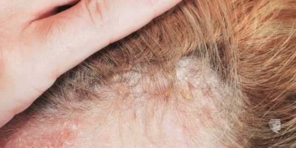 Can a Burning Scalp Lead to Hair Loss?