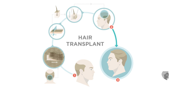 Important things you need to bear in mind before your Hair Transplant