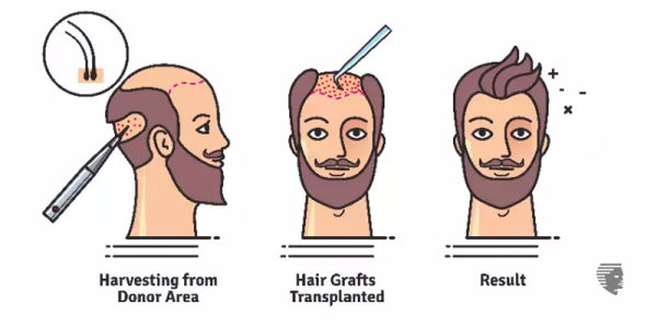 7 most common myths about Hair Transplants!