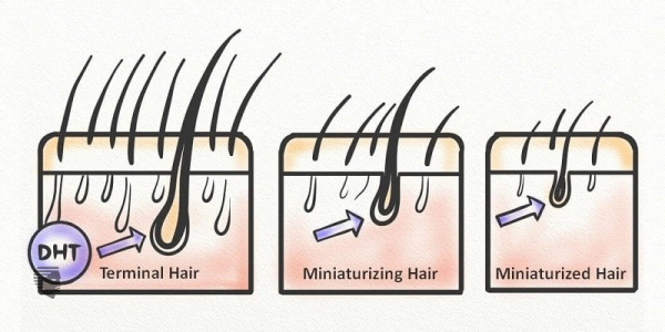 Hormones and Hairloss - Causes Preventions !
