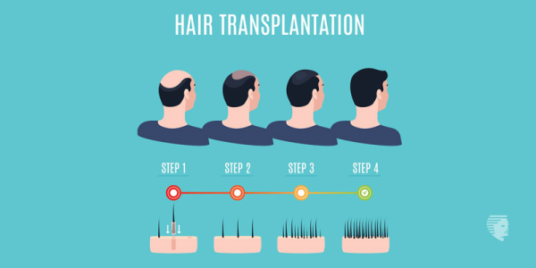 Hair Replacement Surgery: All You Need To Know