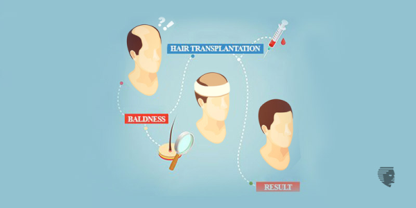 16 Do's and Don'ts for a Successful Hair Transplant