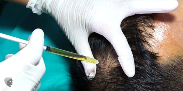 What Can We Expect From Hair Transplant?