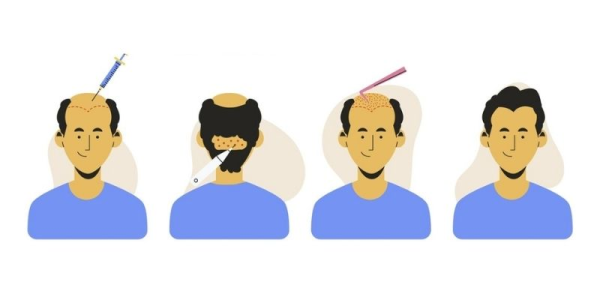 A Guide to Hair Transplant Recovery Timeline