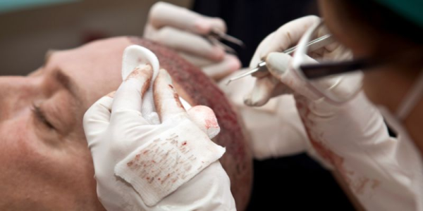 Hair Transplants for Weak Donor Areas: A Complete Guide