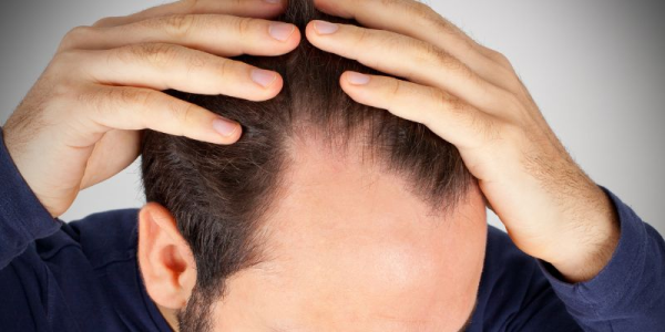 Hairline Transplant for a Receding Hairline