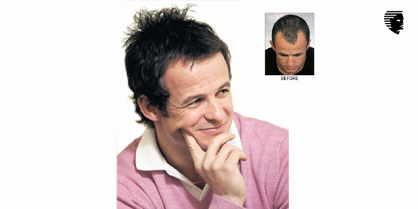 Austin Healey's Remarkable Hair Restoration Journey with Advanced Hair Studio