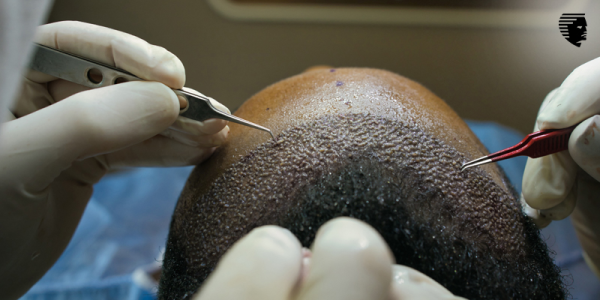 The Lowdown on FUE Hair Transplants: Hair Restoration Secrets Revealed!