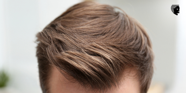 What Will You Look Like After a Hair Transplant?