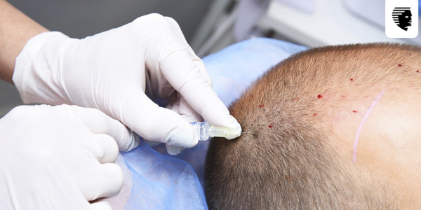 How Effective is PRP Treatment for Androgenetic Alopecia
