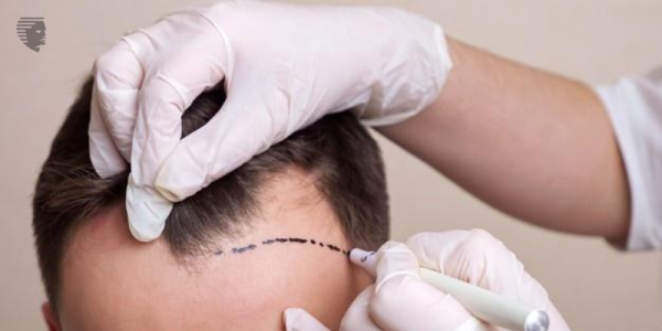 Is a Hair Transplant The Best Solution for Male Baldness