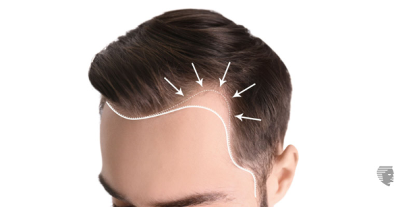 How to Prevent Traction Alopecia? Causes & Treatment for It