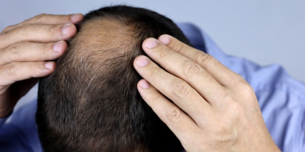 Self Hair Checks: The First Step to Preventing Hair Loss