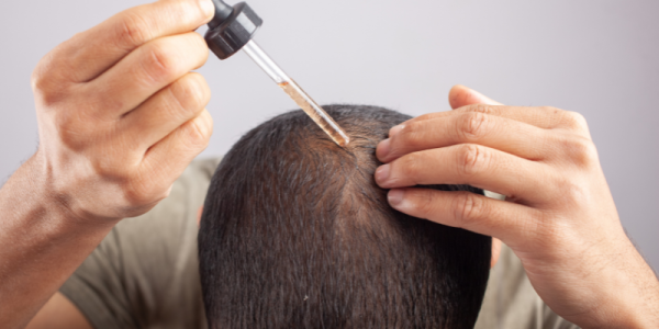 Minoxidil, PRP, or Transplant? Choosing the Right Hair Loss Treatment