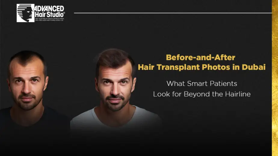 Before and After Hair Transplant Photos in Dubai