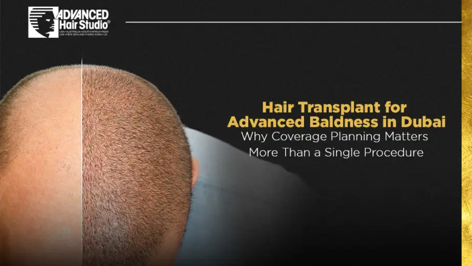 hair transplant for advanced baldness dubai